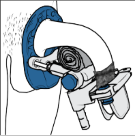 Image d'illustration sur la bonne utilisation du produit Restorex pour un cas particulier.