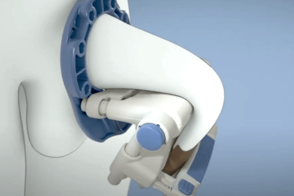 Medical device for penile curvature correction, featuring adjustable blue and white components on a torso model.