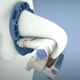 Medical device for penile curvature correction, featuring adjustable blue and white components on a torso model.